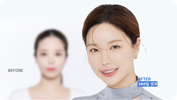 이마축소 흉터 커버