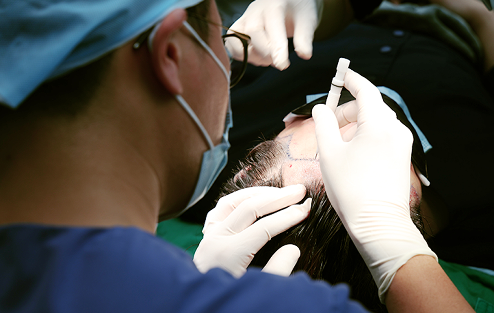 Hair Transplant Procedure Process