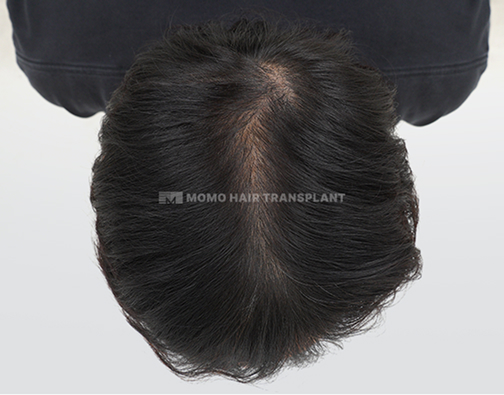 女性头顶植发 after