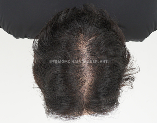 女性额头提升疤痕覆盖非切开 after