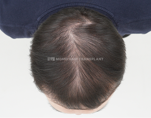 女性头顶植发 before