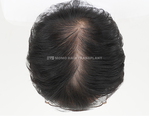女性头顶植发 before