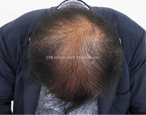 女性额头提升疤痕覆盖非切开 before