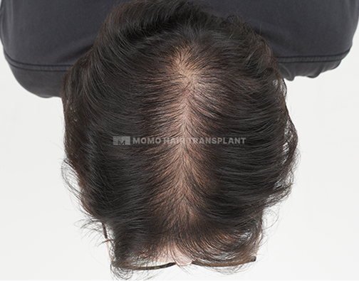 女性额头提升疤痕覆盖非切开 before