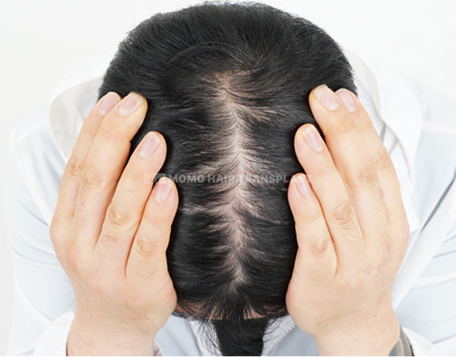 女性额头提升疤痕覆盖非切开 before