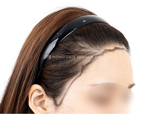 轮廓手术疤痕覆盖非切开毛发移植 before