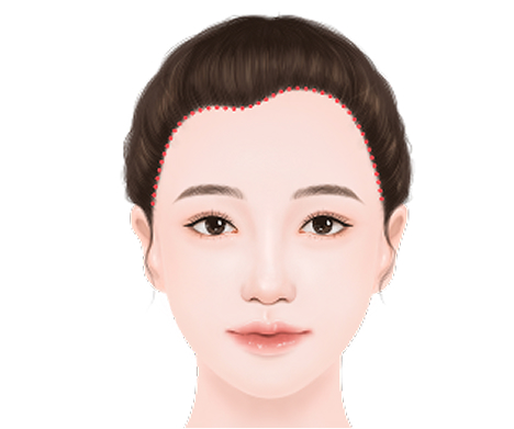不对称额头