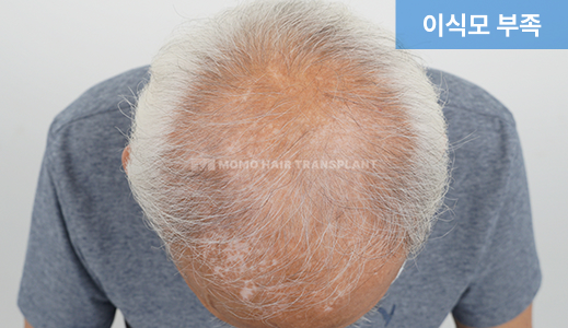 이식모 부족