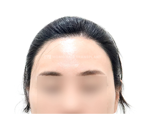 女性切开式植发 after