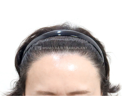 女性切开式植发 after