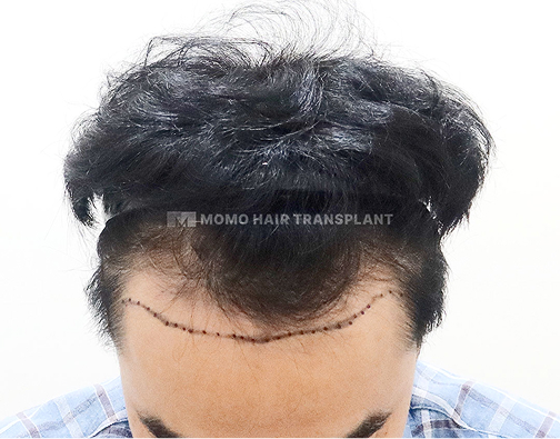 男性切开式植发 before
