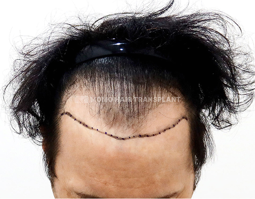 男性切开式植发 before