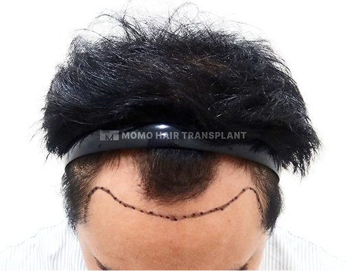 男性切开式植发 before