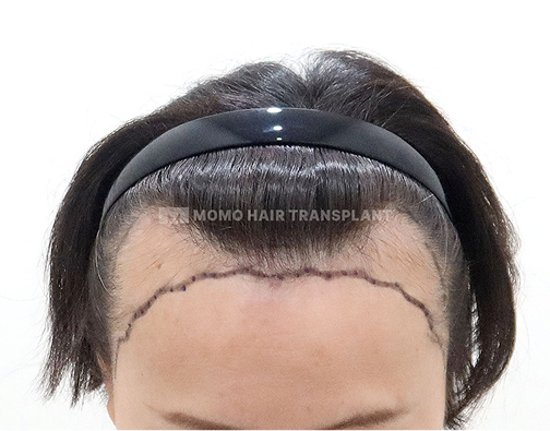 女性切开式植发 before