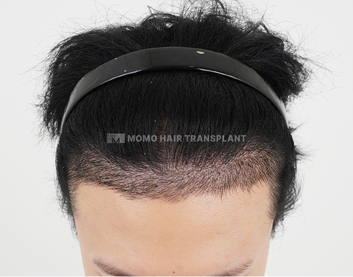 Forehead lift scar cover non-incisional hair transplant after