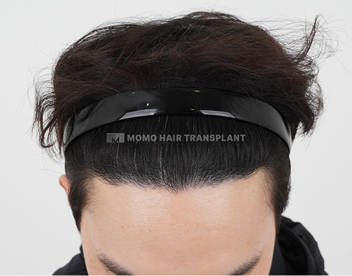 Forehead reduction scar cover incisional hair transplant after