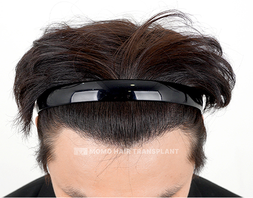 Forehead reduction scar cover incisional hair transplant after