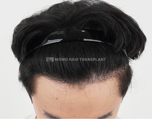 Forehead lift scar cover non-incisional hair transplant after