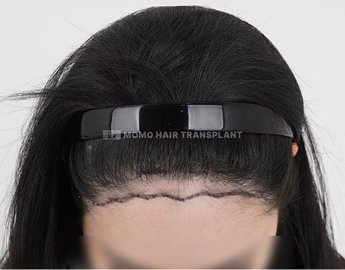 Contour surgery scar cover non-incisional hair transplant before