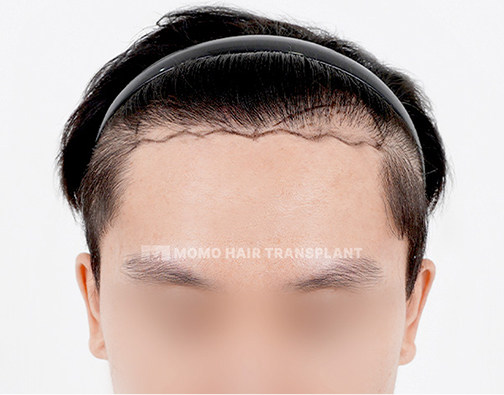 Forehead lift scar cover incisional hair transplant before
