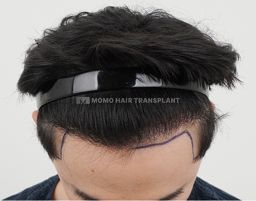 Forehead lift scar cover non-incisional hair transplant before
