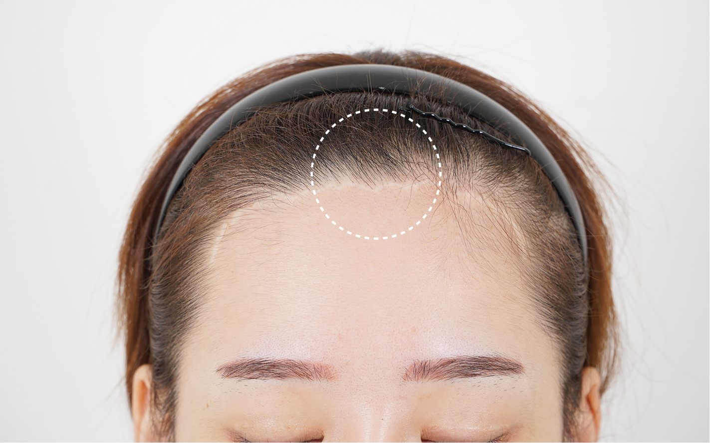 Forehead reduction / forehead lift scar