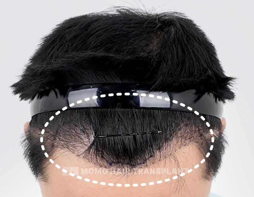 Hairline deformation due to surgery
