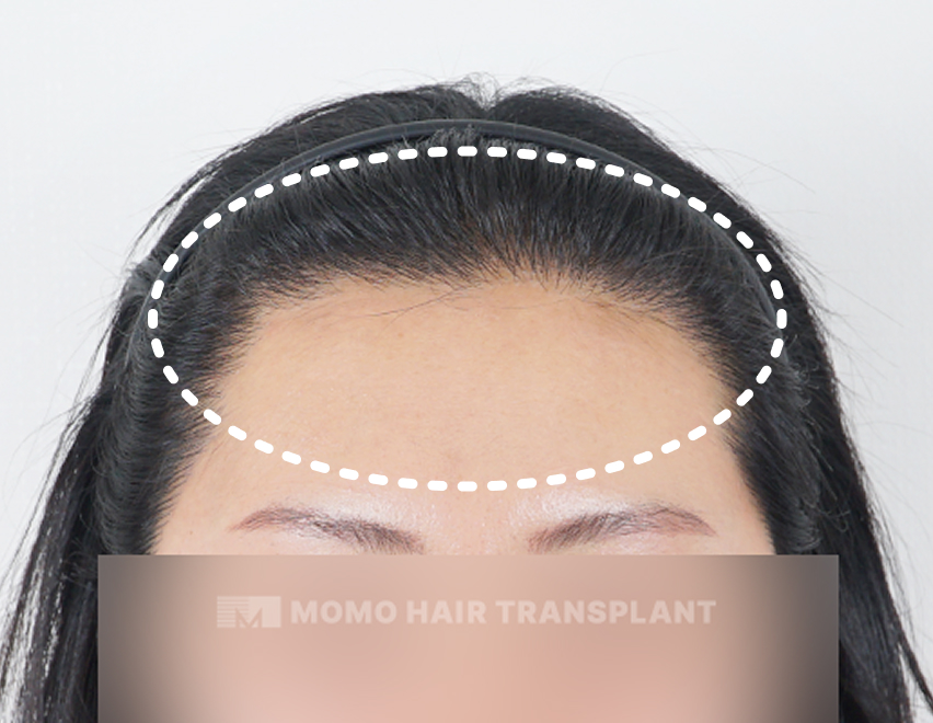 Hairline deformation due to surgery