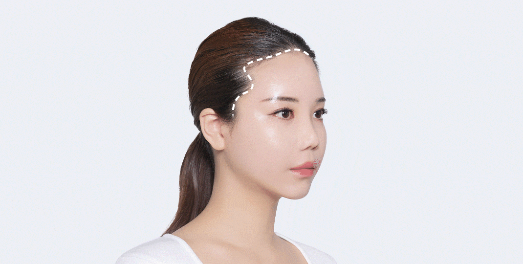 Special reason for MOMO scar cover hair transplant