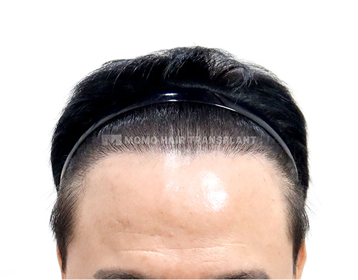 男性非切开式毛发移植 术后