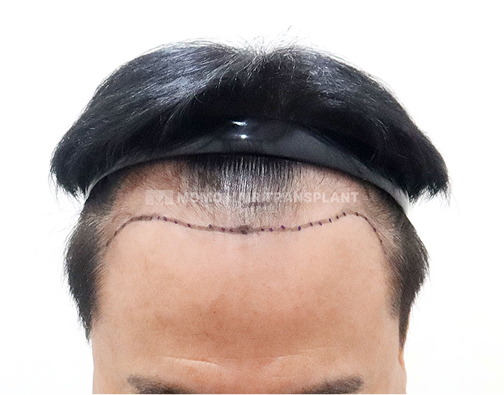 男性非切开式毛发移植 术前