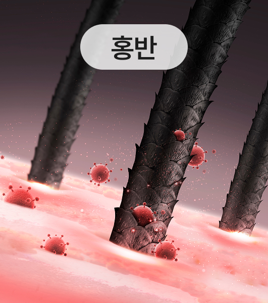 홍반