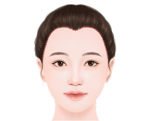M자형 이마